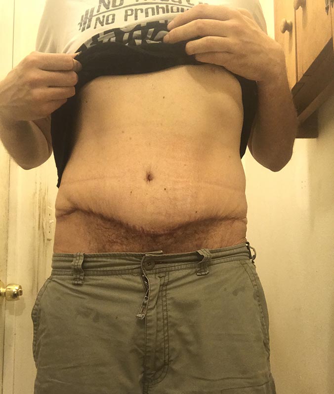 Rich Before Abdominoplasty